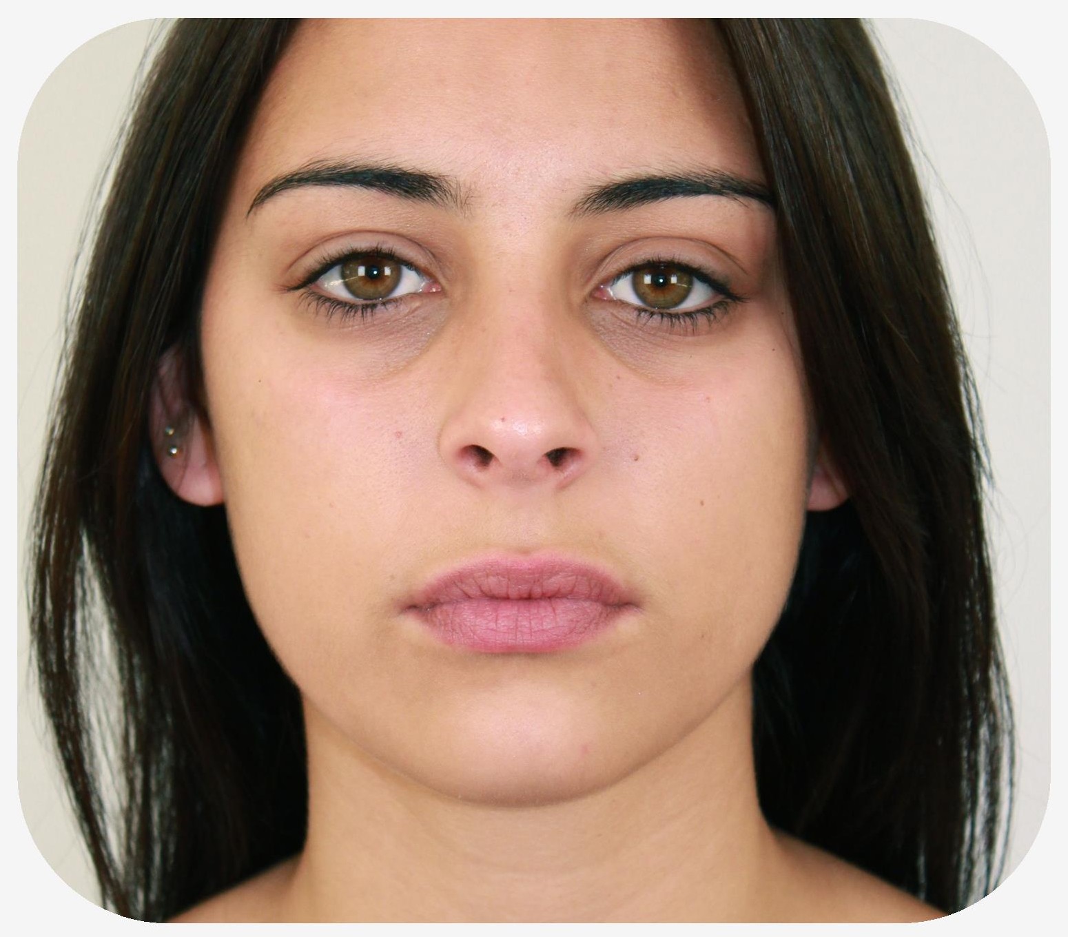 Woman who no longer has bags under her eyes